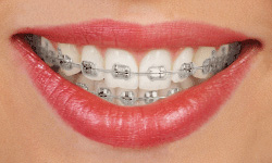 Rubber Bands for Braces  Hidden Valley Orthodontics